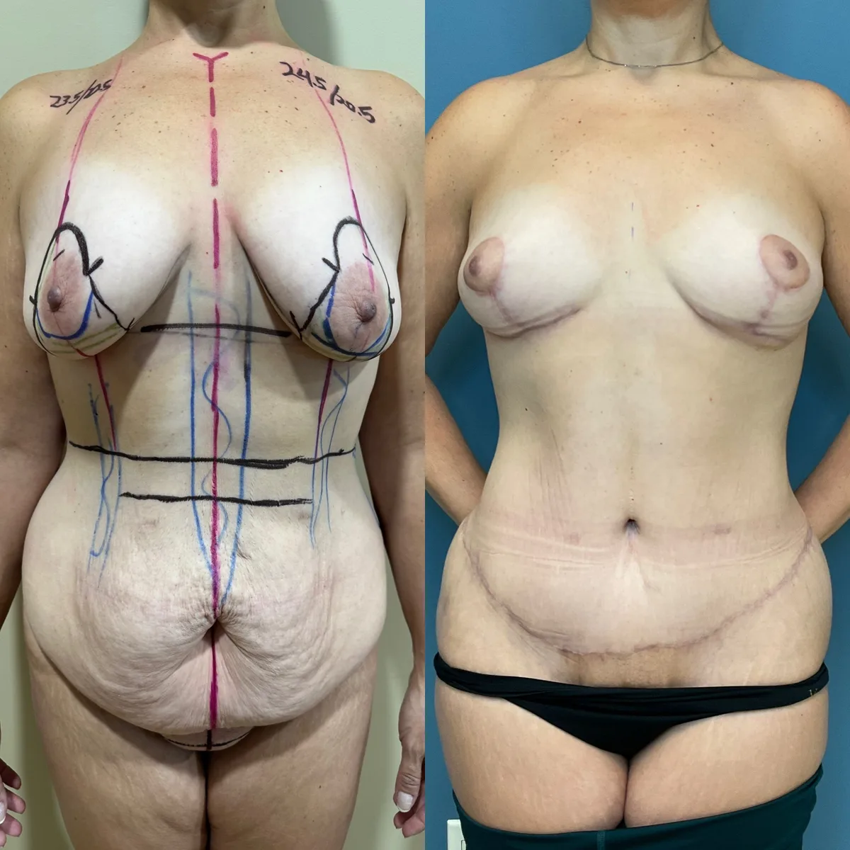 Tummy Tuck + Liposuction + Breast Lift — before and after result by Dr. Jonathan Zaga