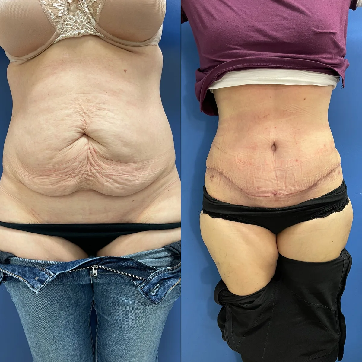 Tummy Tuck (Abdominoplasty) — before and after result by Dr. Jonathan Zaga
