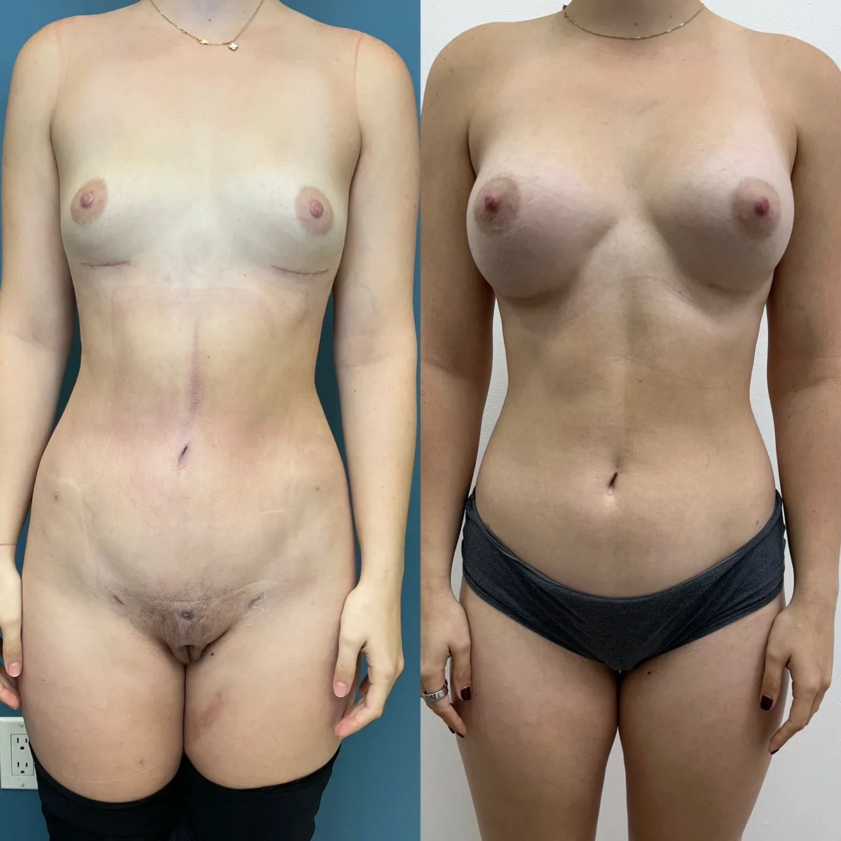 Implant Removal + Liposuction — before and after result by Dr. Jonathan Zaga