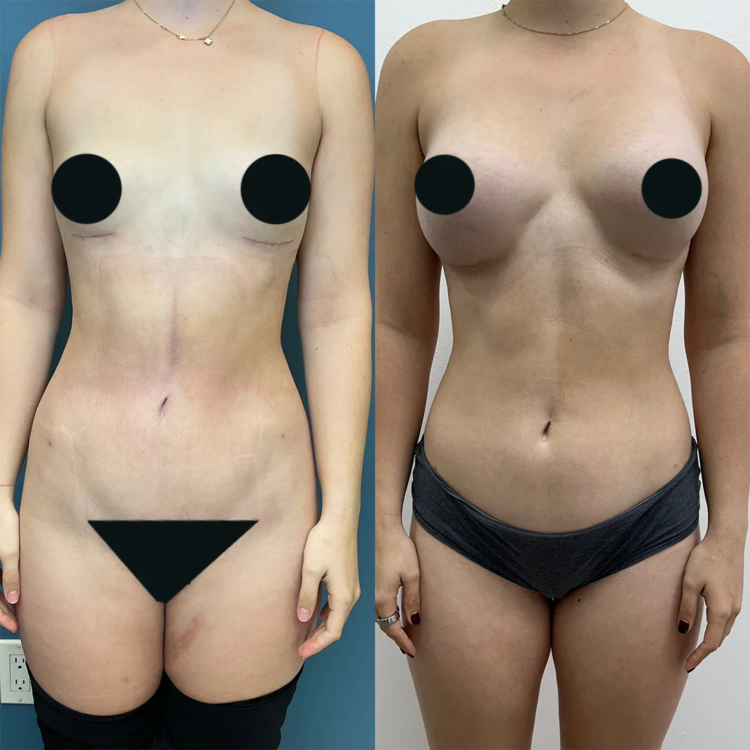 Implant Removal + Liposuction — before and after result by Dr. Jonathan Zaga