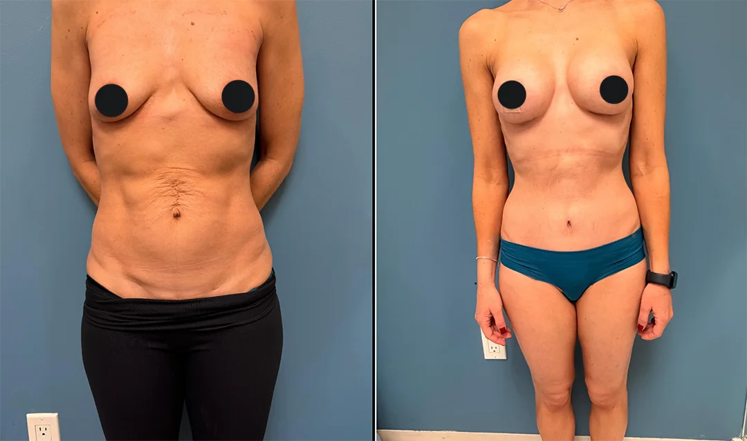 Breast Augmentation + Mini Tummy Tuck — before and after result by Dr. Jonathan Zaga