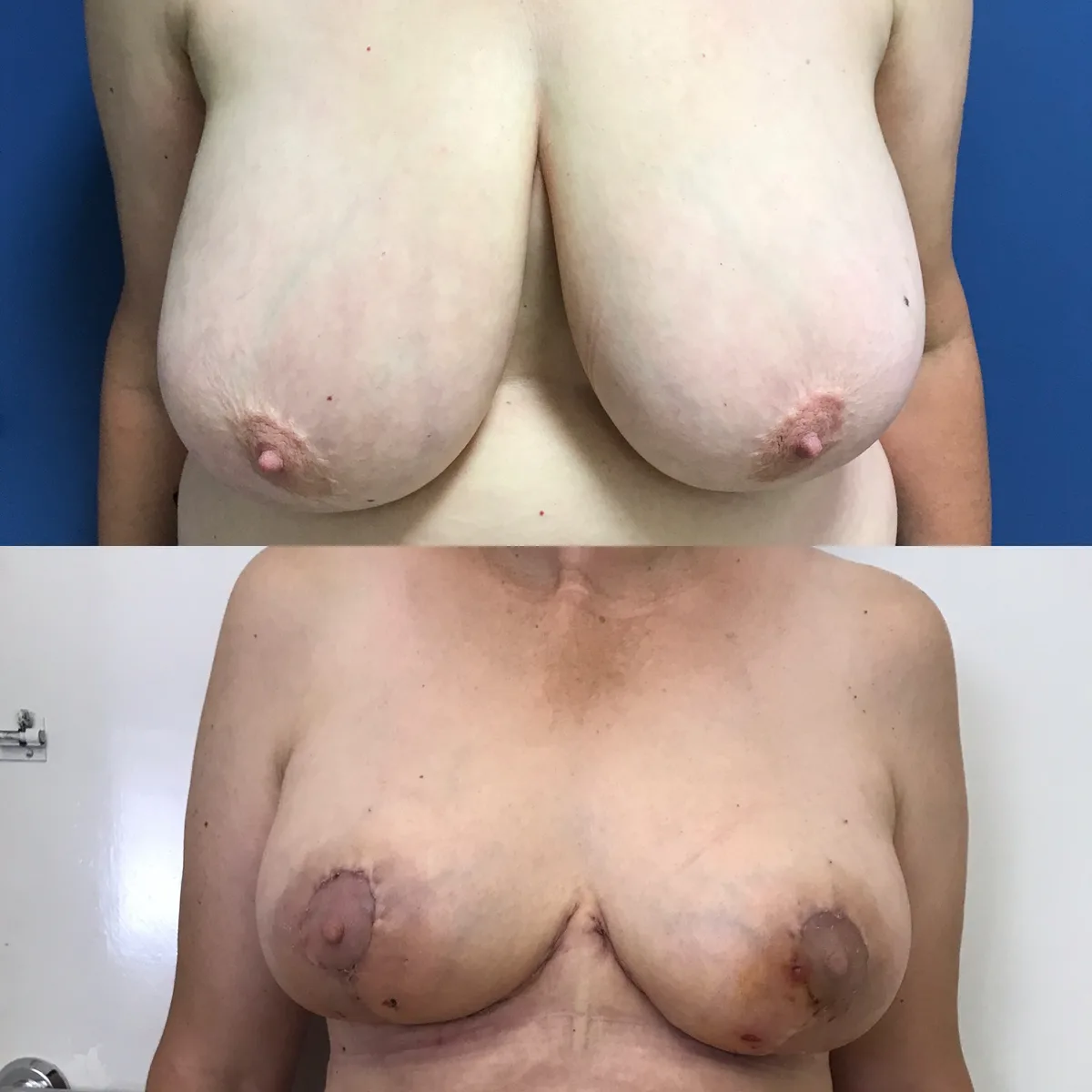 Breast Reduction with Lift — before and after result by Dr. Jonathan Zaga