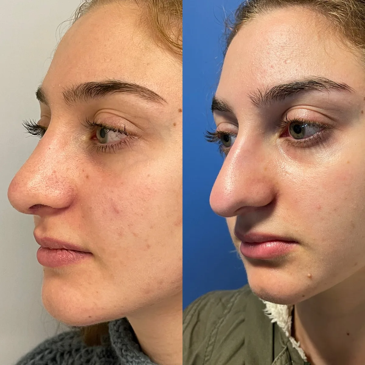 Rhinoplasty — before and after result by Dr. Jonathan Zaga